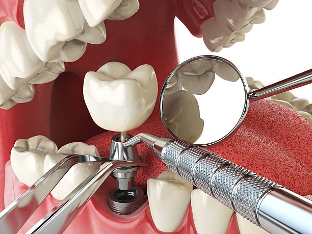 Best Emergency Dentist for Lost Fillings or Crowns in Chula Vista, TX